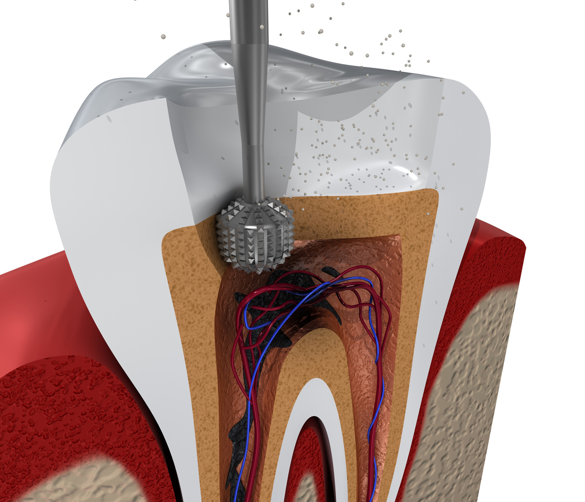 Root canal treatment process. 3D illustration